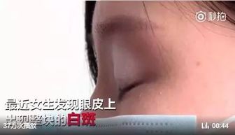 均匀改写，美国女孩白癜风奇迹康复